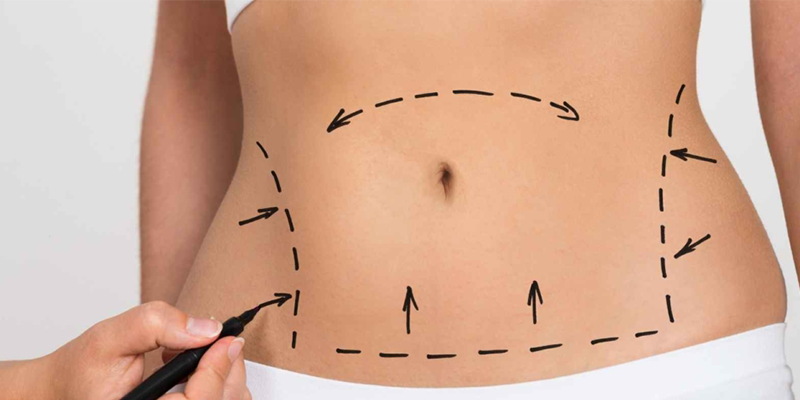 Abdomınoplasty