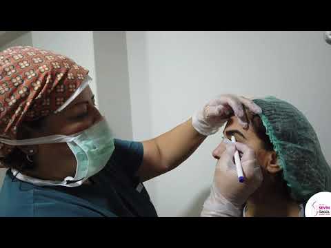 We are planning for lipo injection before the procedure I DR.SEVİN ÖZGÜL